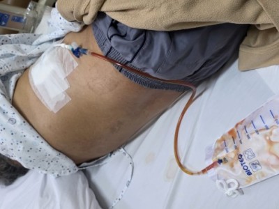 Chemo Treatment